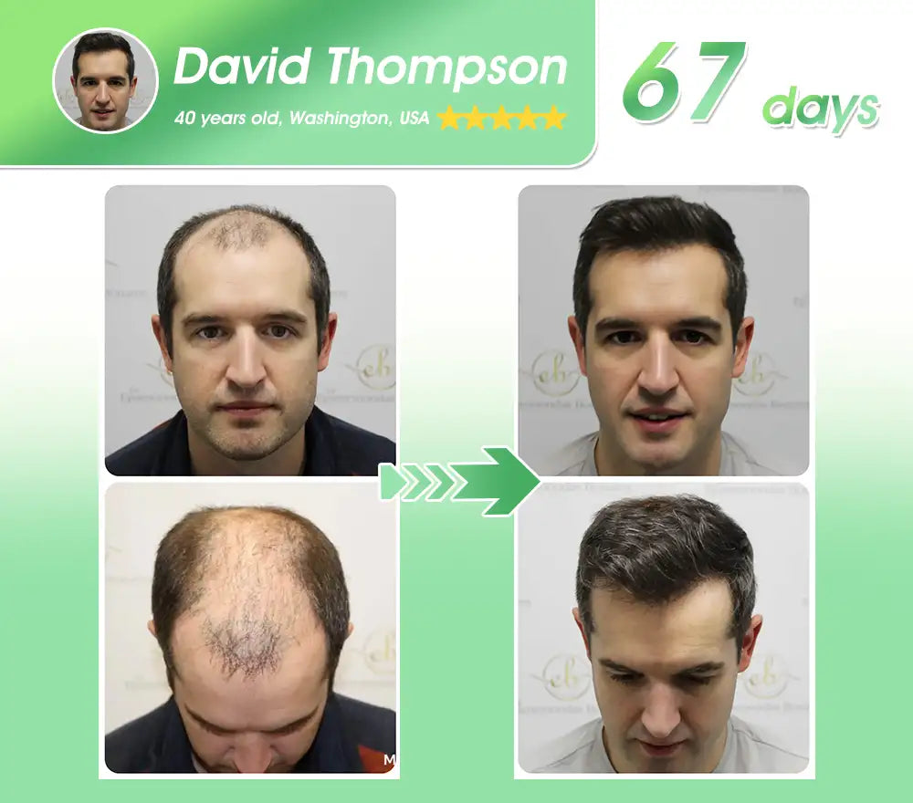 𝐅𝐃𝐀 | 𝐃𝐞𝐞𝐕𝐨𝐨®🇺🇸 𝐅𝐆𝐅-𝟕 𝐆𝐫𝐨𝐰𝐭𝐡 𝐀𝐜𝐭𝐢𝐯𝐚𝐭𝐢𝐨𝐧 𝐇𝐚𝐢𝐫 𝐑𝐞𝐠𝐫𝐨𝐰𝐭𝐡 & 𝐅𝐨𝐥𝐥𝐢𝐜𝐥𝐞 𝐑𝐞𝐩𝐚𝐢𝐫 𝐎𝐫𝐚𝐥 𝐋𝐢𝐪𝐮𝐢𝐝(Just once a day, visible changes in 7 days)For severe hair loss, alopecia areata, folliculitis, seborrheic dermatitis,scalp psoriasis, and other chronic scalp conditions