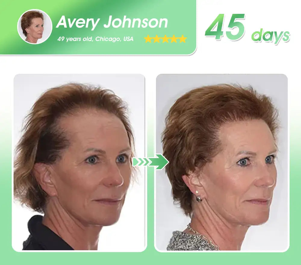 𝐅𝐃𝐀 | 𝐃𝐞𝐞𝐕𝐨𝐨®🇺🇸 𝐅𝐆𝐅-𝟕 𝐆𝐫𝐨𝐰𝐭𝐡 𝐀𝐜𝐭𝐢𝐯𝐚𝐭𝐢𝐨𝐧 𝐇𝐚𝐢𝐫 𝐑𝐞𝐠𝐫𝐨𝐰𝐭𝐡 & 𝐅𝐨𝐥𝐥𝐢𝐜𝐥𝐞 𝐑𝐞𝐩𝐚𝐢𝐫 𝐎𝐫𝐚𝐥 𝐋𝐢𝐪𝐮𝐢𝐝(Just once a day, visible changes in 7 days)For severe hair loss, alopecia areata, folliculitis, seborrheic dermatitis,scalp psoriasis, and other chronic scalp conditions