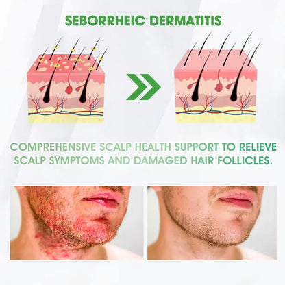 𝐅𝐃𝐀 | 𝐃𝐞𝐞𝐕𝐨𝐨®🇺🇸 𝐅𝐆𝐅-𝟕 𝐆𝐫𝐨𝐰𝐭𝐡 𝐀𝐜𝐭𝐢𝐯𝐚𝐭𝐢𝐨𝐧 𝐇𝐚𝐢𝐫 𝐑𝐞𝐠𝐫𝐨𝐰𝐭𝐡 & 𝐅𝐨𝐥𝐥𝐢𝐜𝐥𝐞 𝐑𝐞𝐩𝐚𝐢𝐫 𝐎𝐫𝐚𝐥 𝐋𝐢𝐪𝐮𝐢𝐝(Just once a day, visible changes in 7 days)For severe hair loss, alopecia areata, folliculitis, seborrheic dermatitis,scalp psoriasis, and other chronic scalp conditions